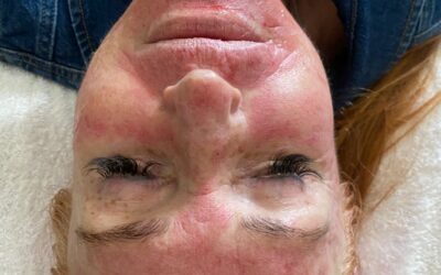 Benefits of Micro Needling