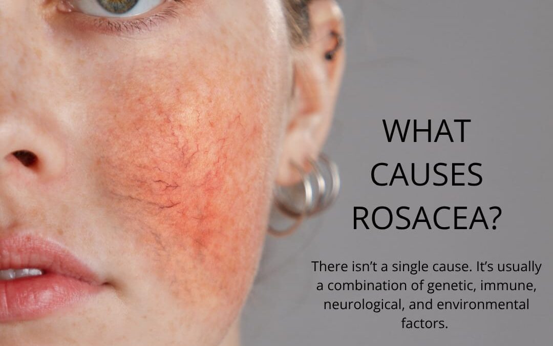 April is Rosacea Awareness Month